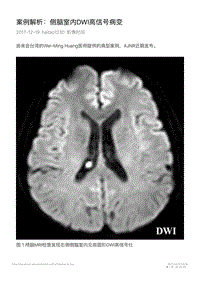 案例解析：侧脑室内DWI高信号病变