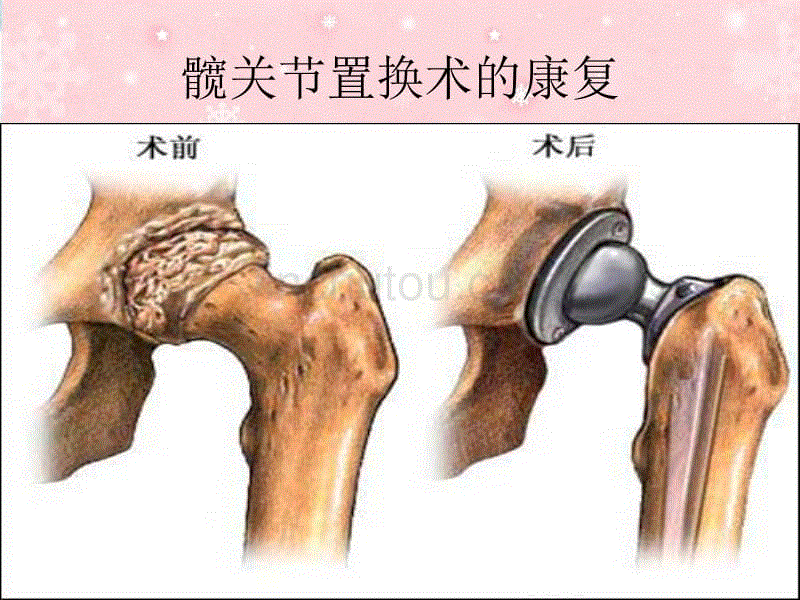 髋关节置换术的康