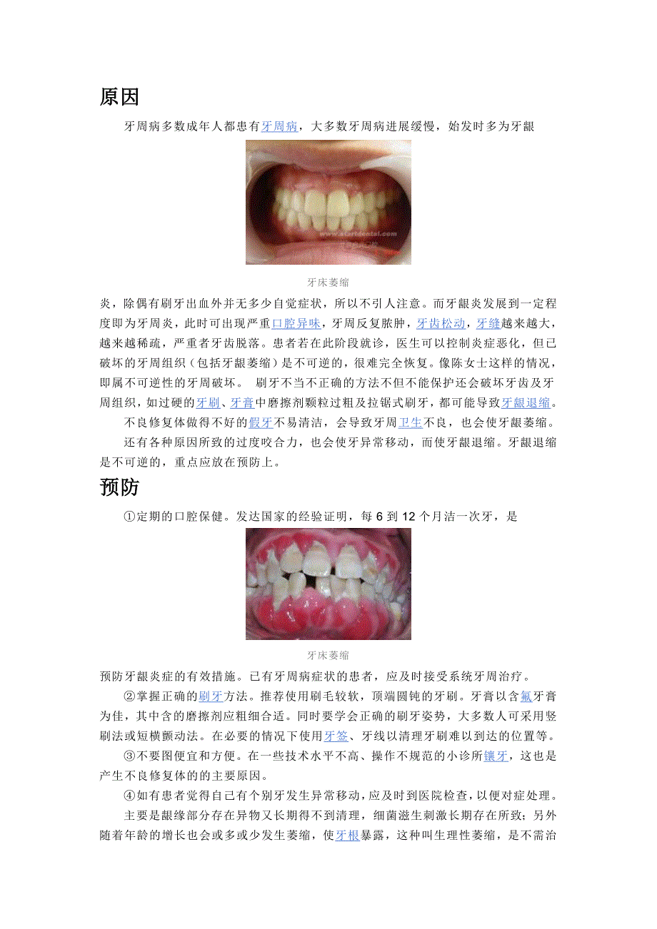 牙床萎缩的成因及防治